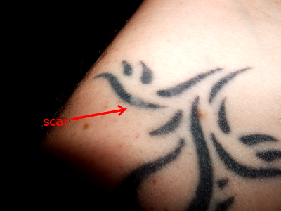 This was really minor - there's no visible scarring on non-tattooed skin.